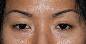 Before Asian Double Eyelid Crease Formation Eyelift Blepharoplasty for The Single Eyelid Fold using the Orbicularis Levator Fixation Technique