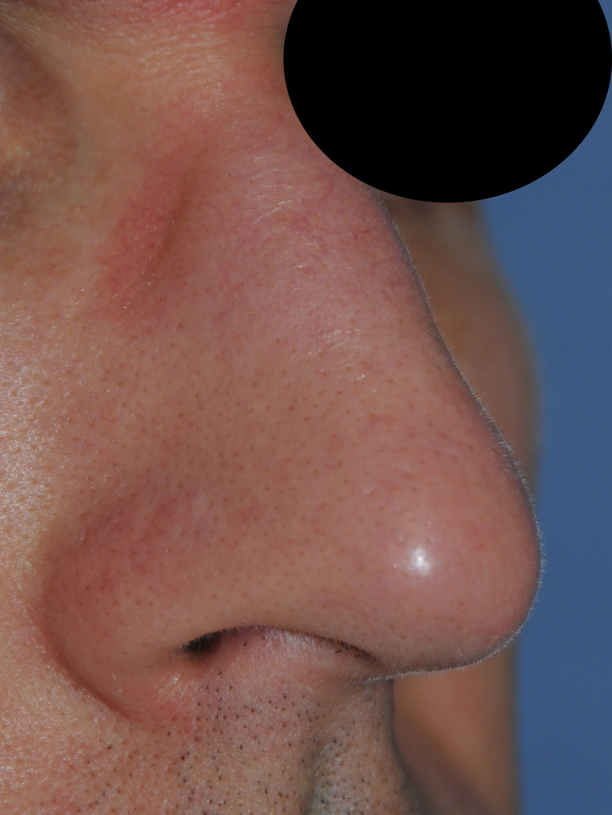 Oblique View After Laser Resurfacing, Dermabrasion to the nose to treat scars, red marks, to improve texture, tone and even the skin appearance for this 40's Caucasian Professional Male from Bellevue, Wa