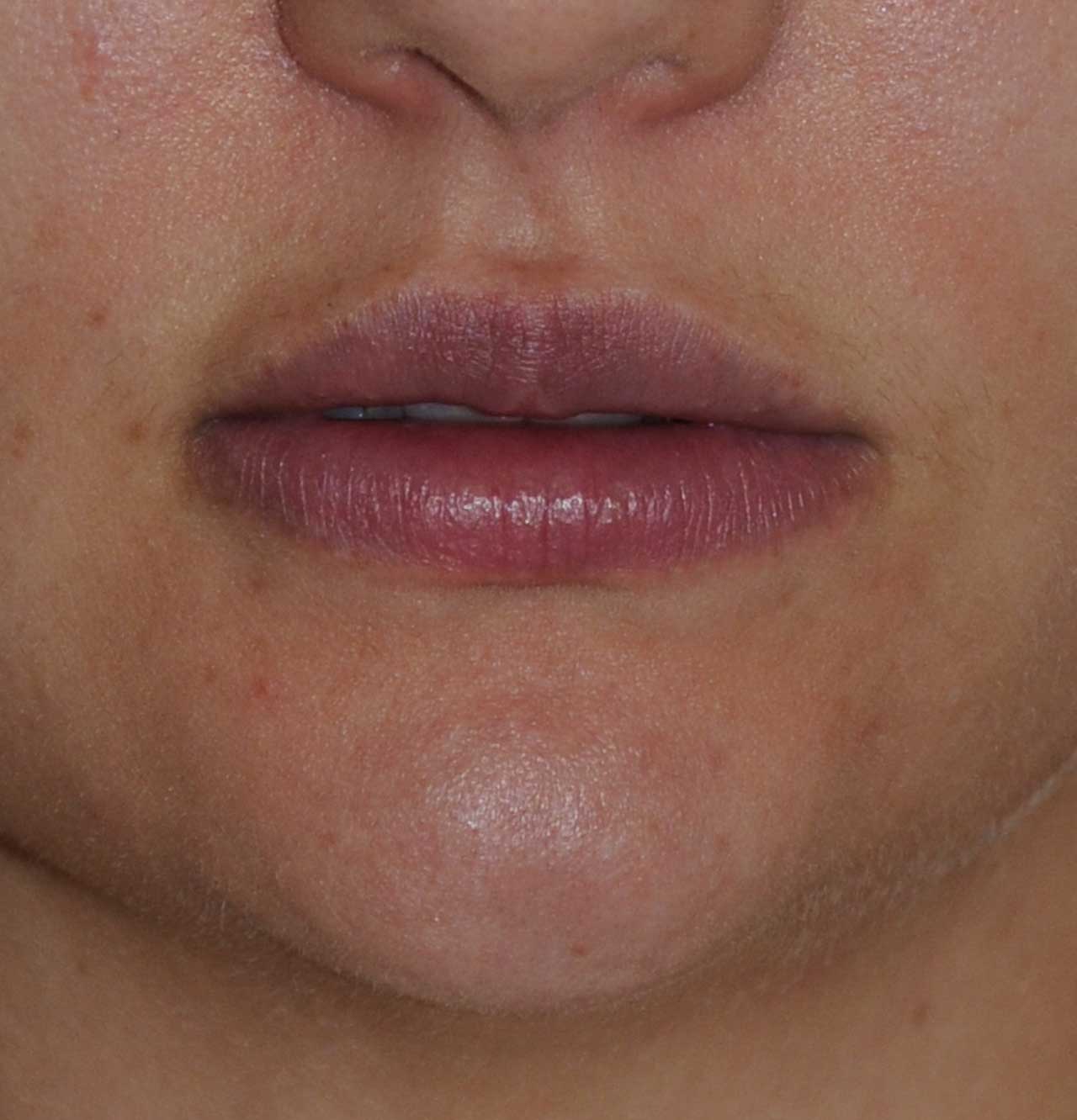 lip implants