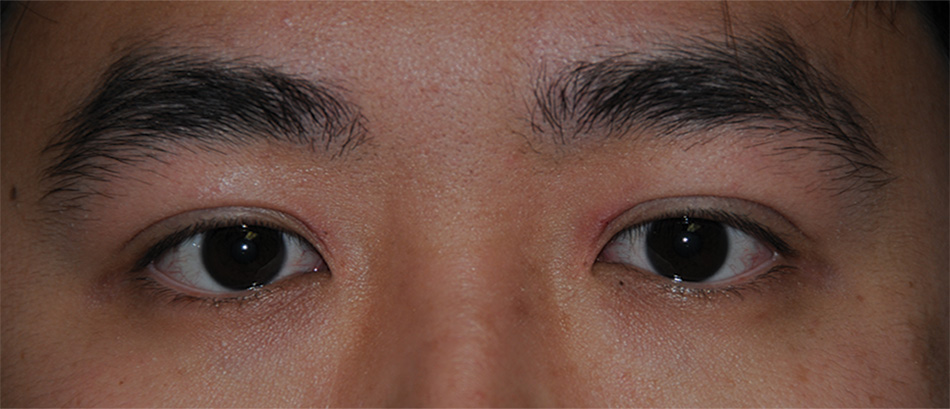 After Asian Double Eyelid Crease Formation Procedure for this Asian 20 Something Male from Eastern Washington