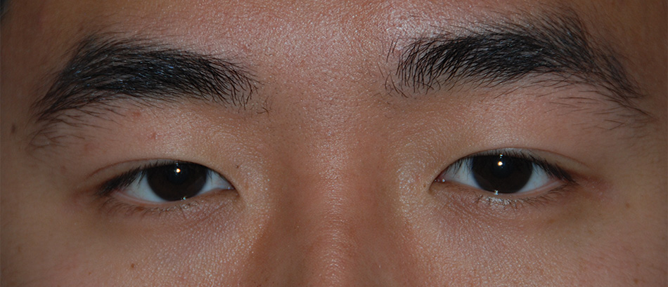 Before Asian Double Eyelid Crease Formation Procedure for this Asian 20 Something Male from Eastern Washington