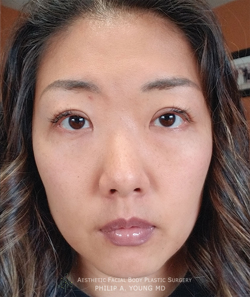 After Asian Double Eyelid Crease Formation Surgery