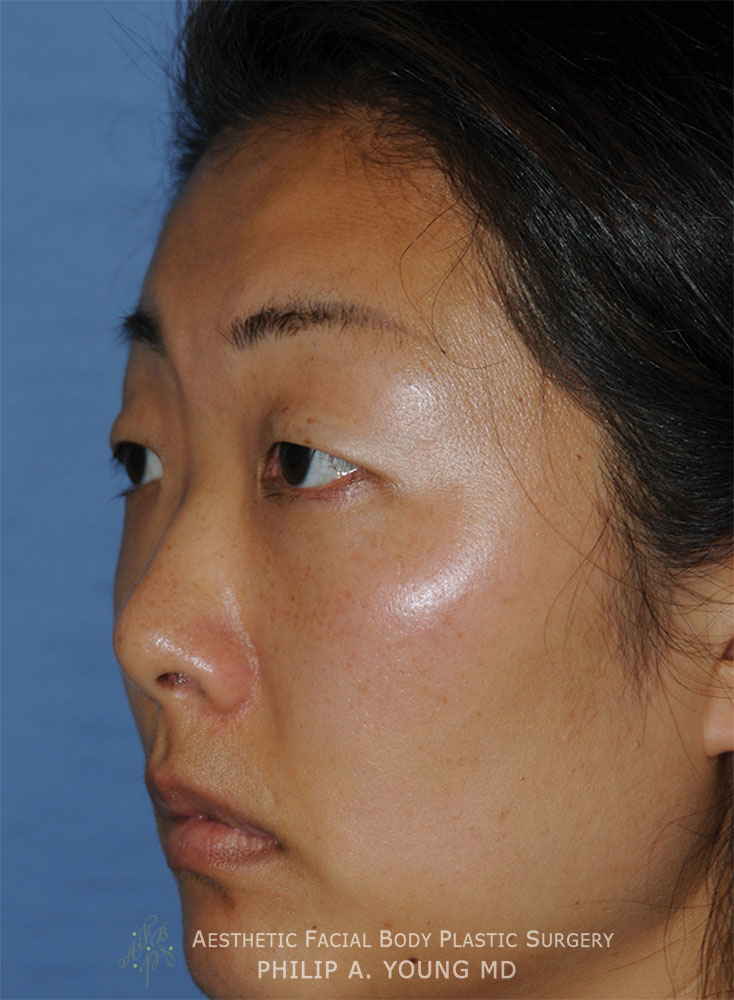 Before Asian Double Eyelid Crease Formation Surgery Left Oblique View