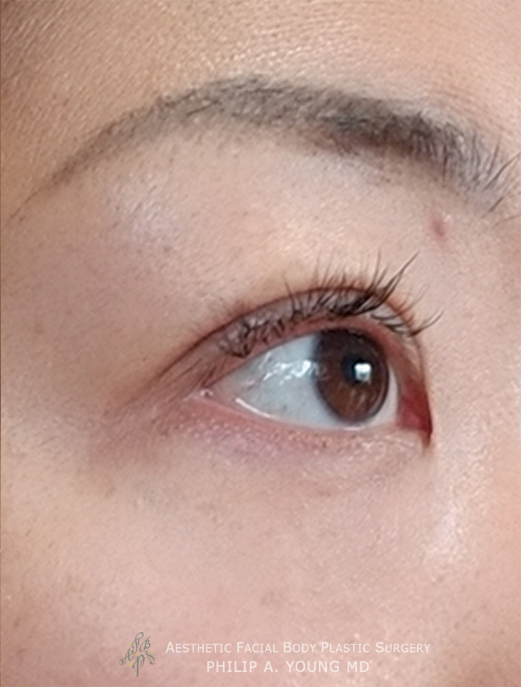 After Asian Double Eyelid Crease Formation Surgery Right Oblique View Close Up