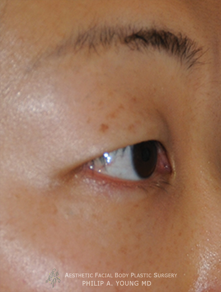 Before Asian Double Eyelid Crease Formation Surgery Right Oblique View Close Up