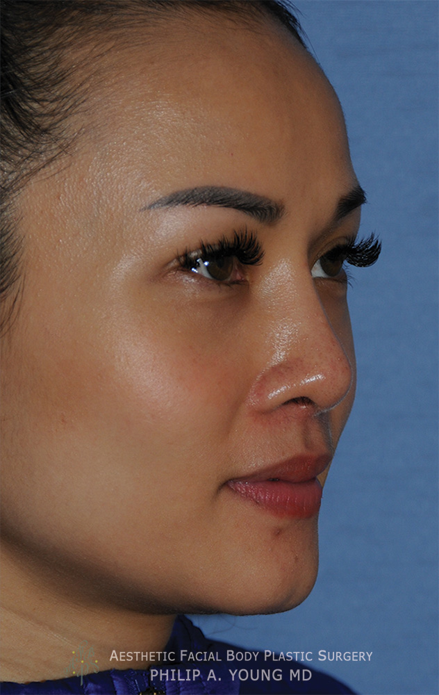 Asian Rhinoplasty with Silicone Implant for Flat Wide Nose After Oblique View