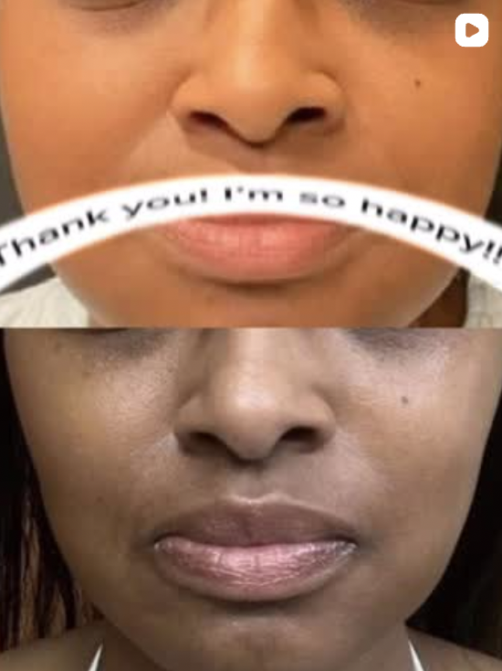 Watch Dr. Young Buccal Fat Removal After One Month