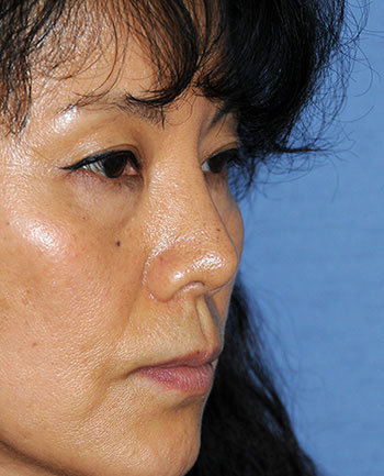 Rhinoplasty Revision surgery After Photo from Dr Philip Young in Bellevue Washington
