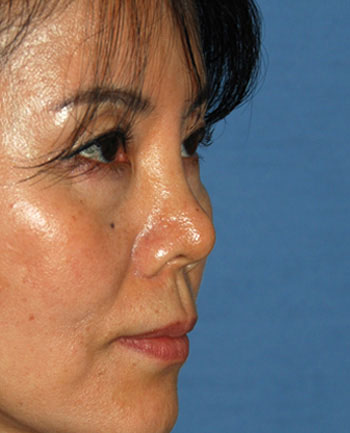 Rhinoplasty Revision surgery Before Photo from Dr Philip Young in Bellevue Washington