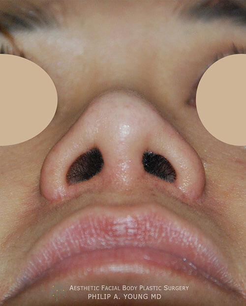 Ethnic rhinoplasty surgical procedure after photo by Dr Philip Young