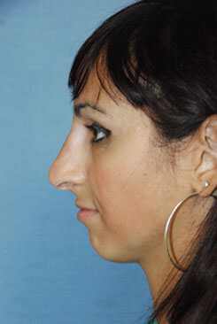Non surgical rhinoplasty after photos Dr Philip Young