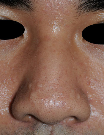 Nose laser resurfacing & scar revision before photo from Dr Philip Young in Beleveu Washington