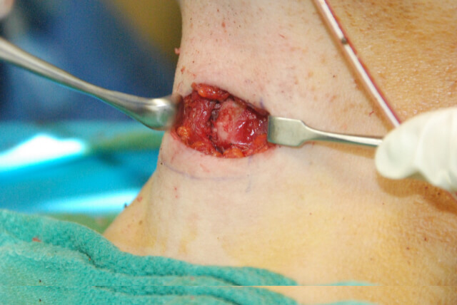 Tracheal Shave Picture in Surgery