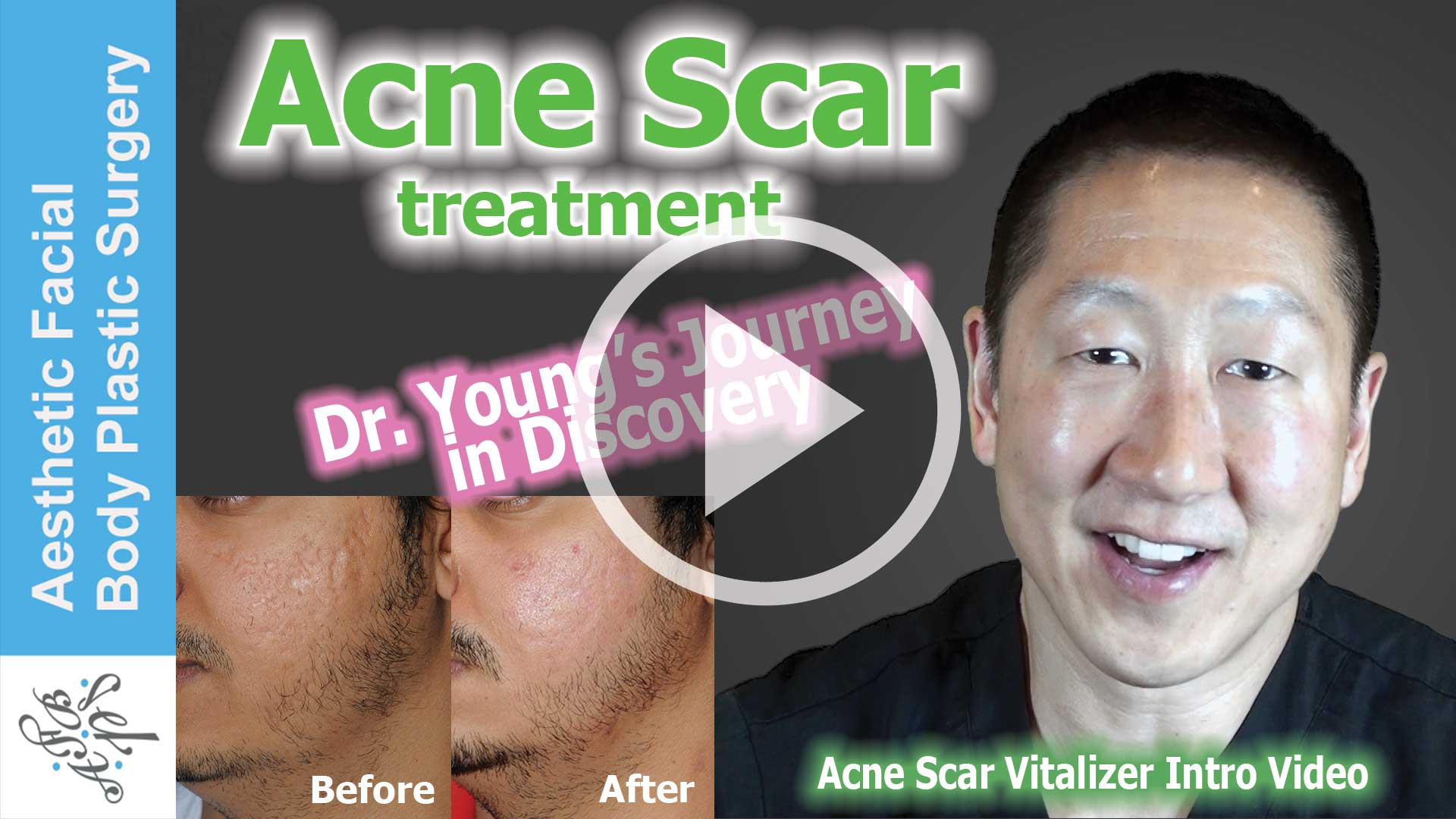 Treat All Types of Acne Scars in One Treatment in 2 Hours with the New Acne Scar Vitalizer Treatment