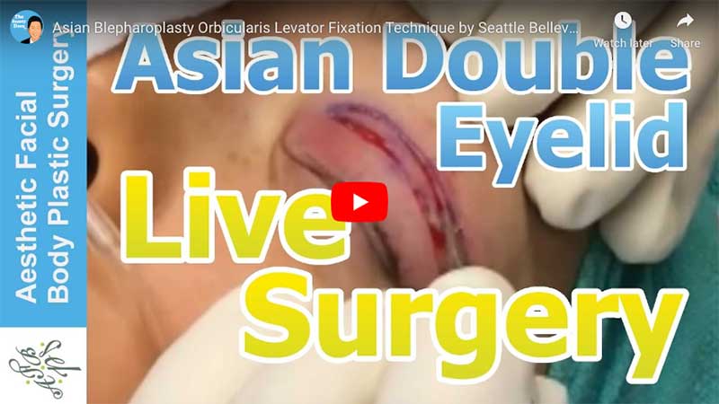 Asian Blepharoplasty Orbicularis Levator Fixation Technique by Seattle Bellevue Dr. Philip Young