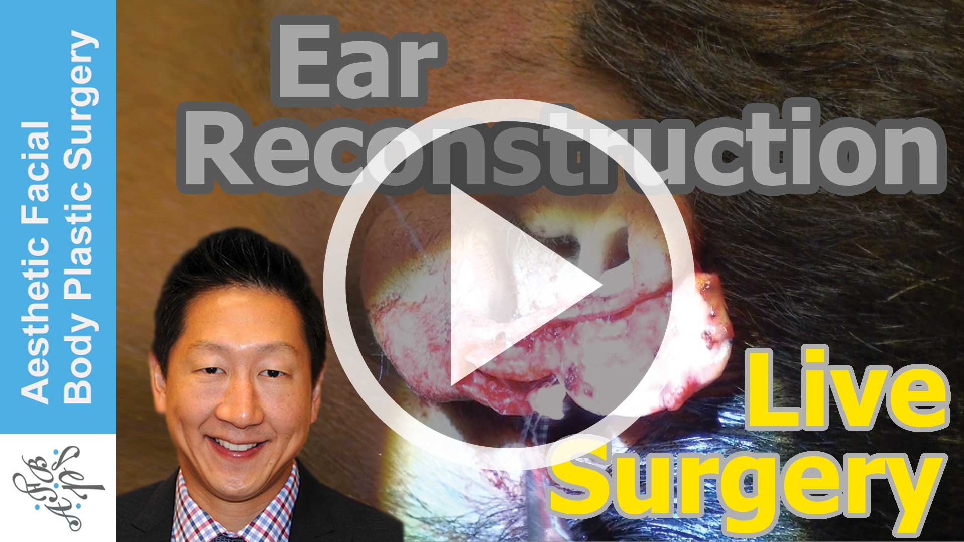 Ear Reconstruction Live Surgery of a Bite Injury of the Top of the Ear by Bellevue Seattle Dr Young