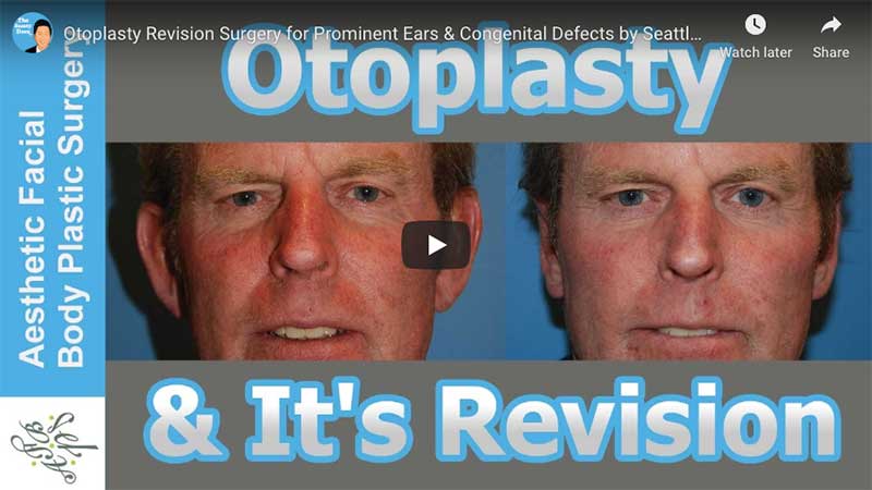 Otoplasty Revision Surgery for Prominent Ears & Congenital Defects by Seattle Bellevue's Dr Young