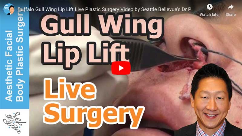 Buffalo Gull Wing Lip Lift Live Plastic Surgery Video by Seattle Bellevue's Dr Philip Young