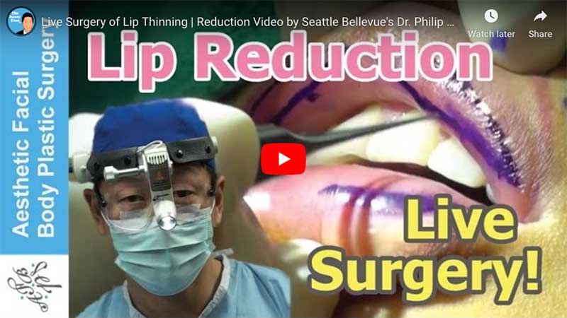 Live Surgery of Lip Thinning | Reduction Video by Seattle Bellevue's Dr. Philip Young