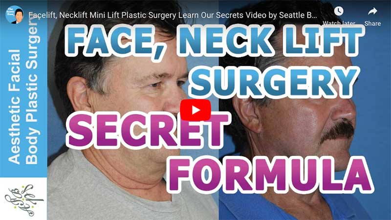 Facelift, Necklift Mini Lift Plastic Surgery Learn Our Secrets Video by Seattle Bellevue's Dr Young