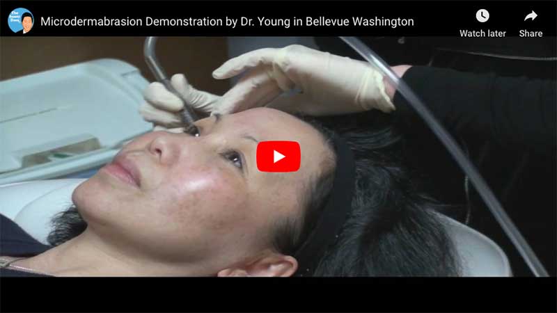 Microdermabrasion Demonstration by Dr. Young in Bellevue Washington