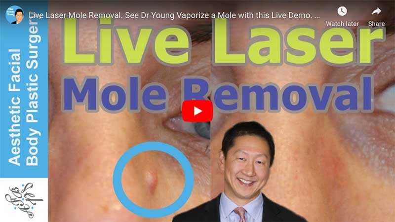 Live Laser Mole Removal. See Dr Young Vaporize a Mole with this Live Demo. Learn About Mole Removal