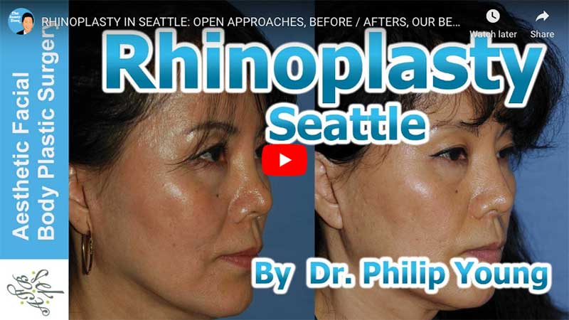 RHINOPLASTY IN SEATTLE: OPEN APPROACHES, BEFORE / AFTERS, OUR BEAUTY THEORY ADVANTAGE WITH DR YOUNG