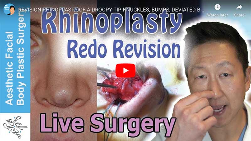 REVISION RHINOPLASTY OF A DROOPY TIP, KNUCKLES, BUMPS, DEVIATED BROKEN NOSE BY SEATTLE'S DR YOUNG
