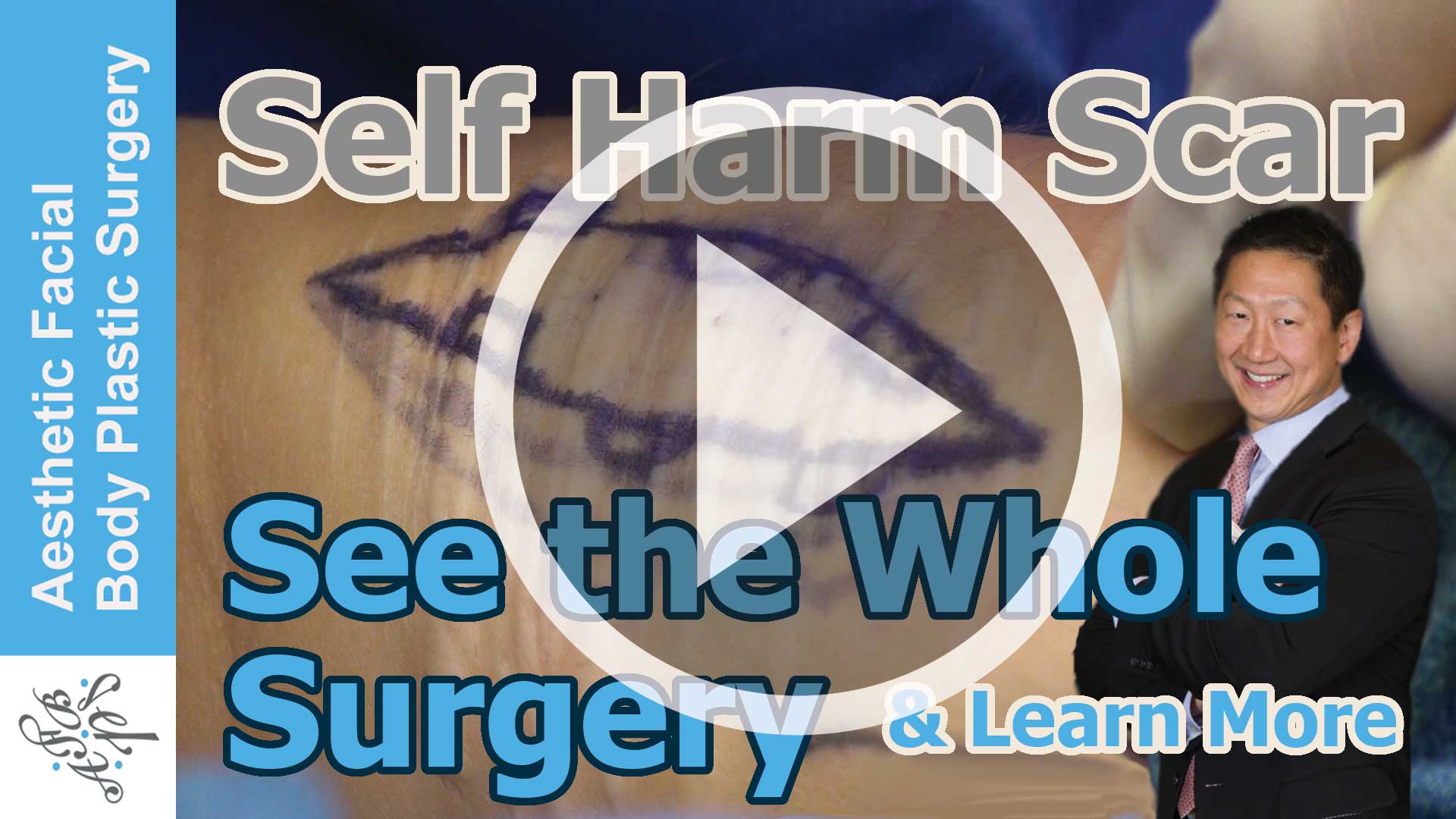 Self Harm Scar of the Arm with Live Video and Surgical Demonstration