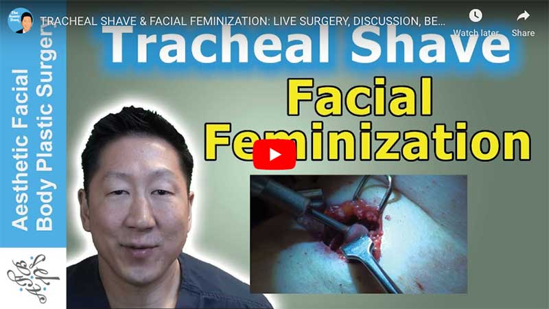 TRACHEAL SHAVE & FACIAL FEMINIZATION: LIVE SURGERY, DISCUSSION, BEFORE & AFTERS