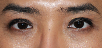 Asian Double Eyelid Crease Formation Surgery