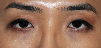 Asian Double Eyelid Crease Formation Surgery