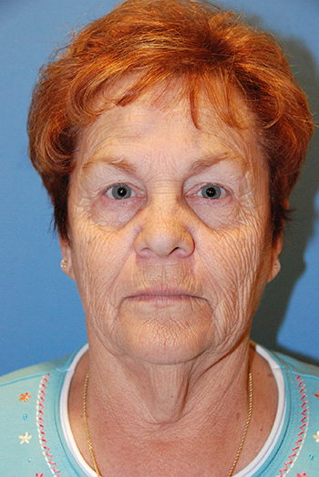 Facelift Before Frontal