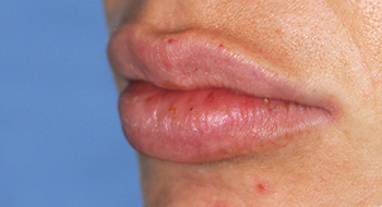 Lip Augmentation | Enhancement After Perma Lip Augmentation