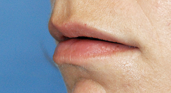 Lip Augmentation | Enhancement After Perma Lip Augmentation