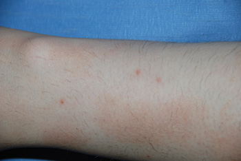 co2 Laser Removal of arm | Mole | Lesion before