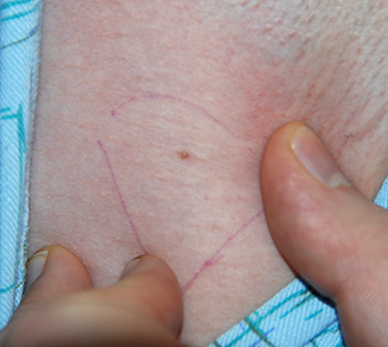 co2 Laser Removal of armpit | Mole | Lesion before