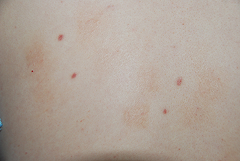 co2 Laser Removal of back | Mole | Lesion before