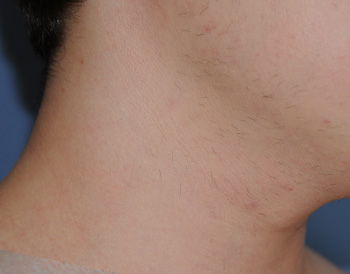 co2 Laser Removal of neck | Mole | Lesion after