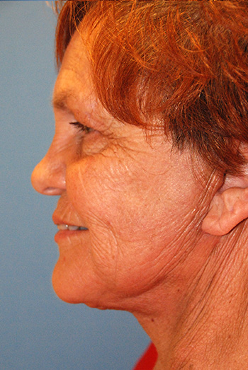 Facelift After Left Lateral