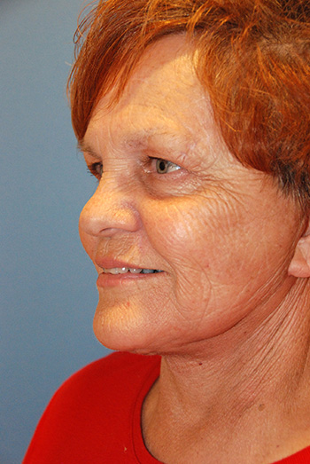 Facelift After Left Oblique