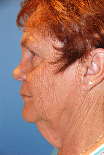 Facelift Before Left Lateral