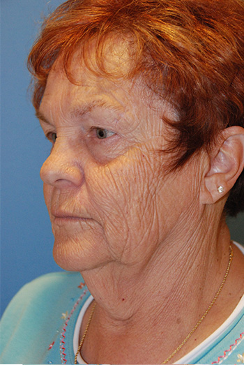 Facelift Before Left Oblique