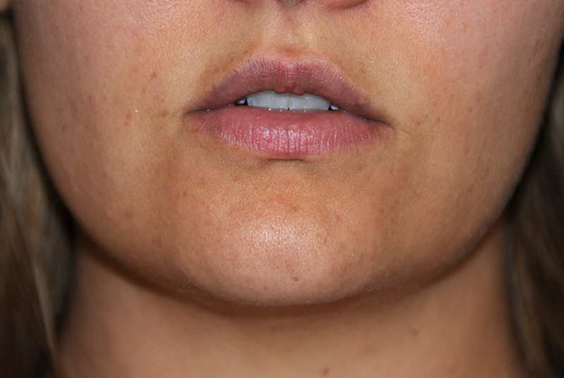 Before Silicone Perma Lip Augmentation