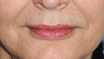 lip augmentation young vitalizer