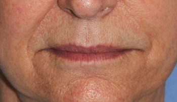 lip augmentation young vitalizer front view before