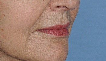 lip augmentation young vitalizer