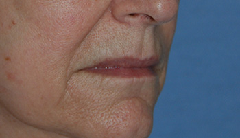 lip augmentation young vitalizer before