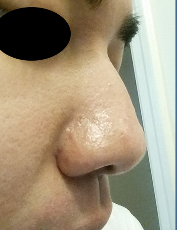 Nose Laser Resurfacing Scar Revision Front Down