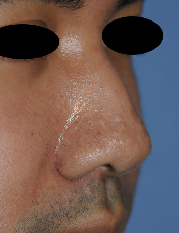 Nose Laser Resurfacing Scar Revision Front Down